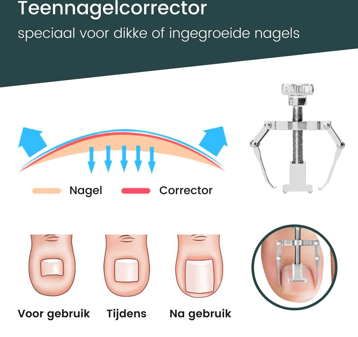 7-Delige Pedicure Set - Nagelverzorging - Nagelset Starterset - Ingegroeide Teennagel - Kalknagelproducten - Pedicuresets - RVS 8 7-Delige Pedicure Set - Nagelverzorging - Nagelset Starterset - Ingegroeide Teennagel - Kalknagelproducten - Pedicuresets - RVS - Afbeelding 8